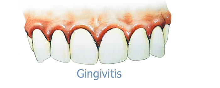 gingivitis