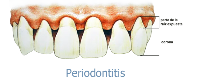 periodontitis