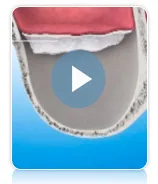 La elevacion del seno maxilar