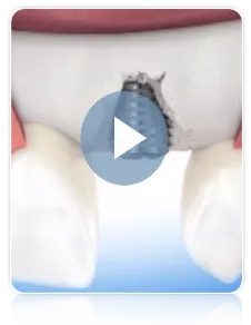 La formación de hueso para implantes dentales