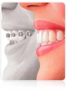 invisalign-getafe-ig