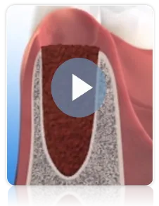 La preservación de hueso en una cirugia dental