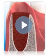 Preservacion de hueso