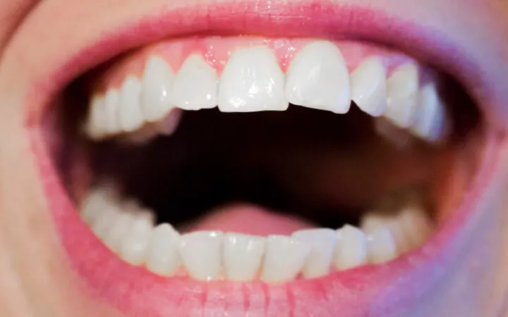 Que Es El Sarro Dental