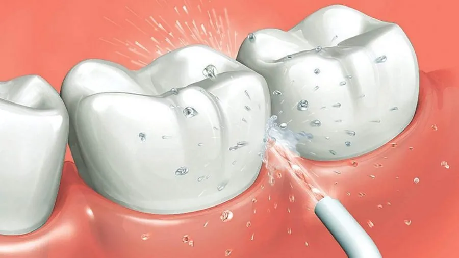 El irrigador bucal eliminando las bacterias de la zona interproximal
