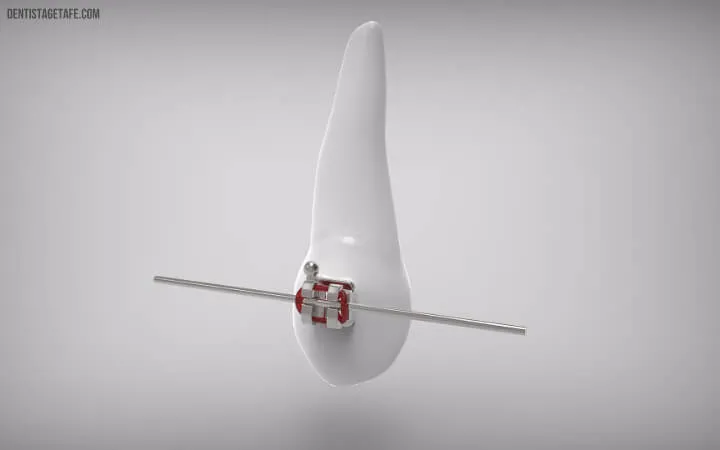 cuidar brackets dentales