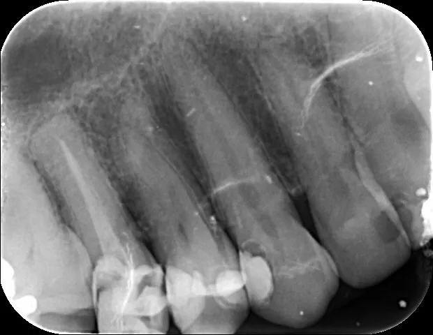 Una radiografía intraroral.